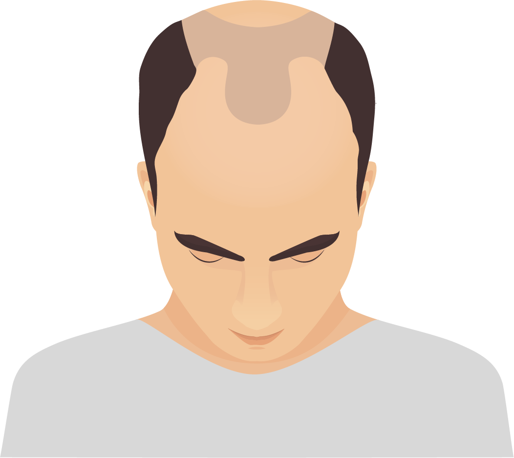 Traumatic or drug-induced alopecia