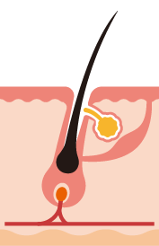 Catagen phase (or resting)