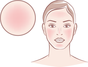 Rosacea or couperosis